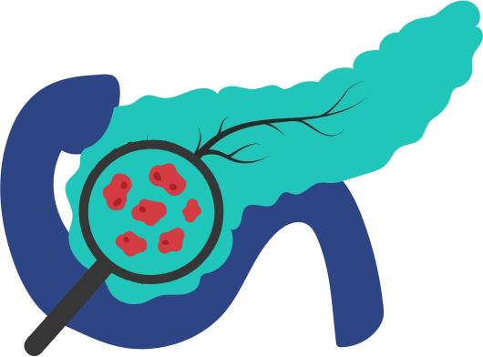 Periampullary Cancers